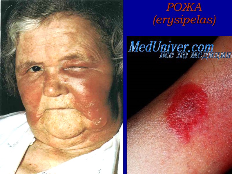 РОЖА  (erysipelas)